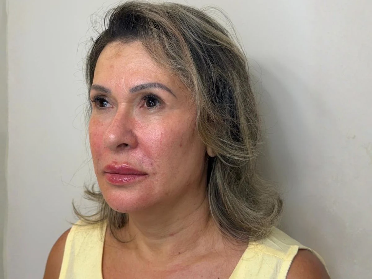 Depois Protocolo Elleve